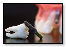 example of dental implant placed by oral surgeon