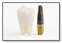 Example tooth and dental implant by oral surgeon