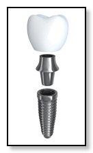 dental implant image titanium metal option