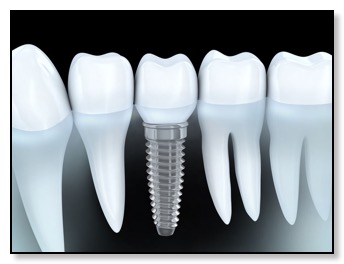 dental implant diagram alternative to rootcanal