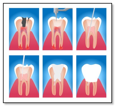 root canal therapy step by step diagram